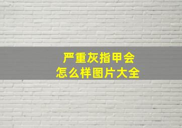 严重灰指甲会怎么样图片大全