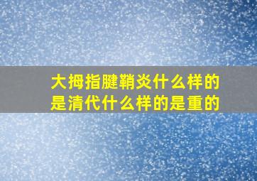 大拇指腱鞘炎什么样的是清代什么样的是重的