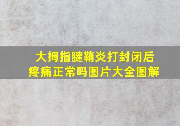 大拇指腱鞘炎打封闭后疼痛正常吗图片大全图解