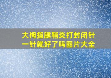 大拇指腱鞘炎打封闭针一针就好了吗图片大全