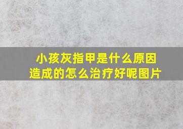 小孩灰指甲是什么原因造成的怎么治疗好呢图片