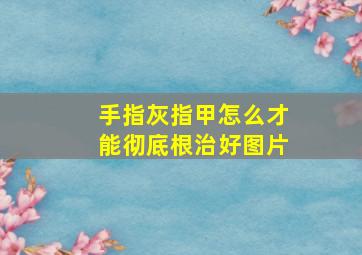 手指灰指甲怎么才能彻底根治好图片