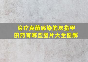 治疗真菌感染的灰指甲的药有哪些图片大全图解