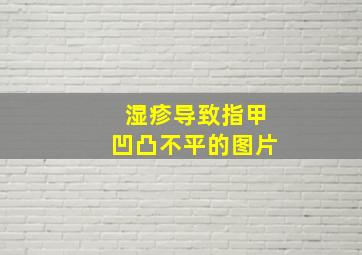 湿疹导致指甲凹凸不平的图片