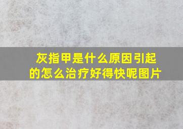 灰指甲是什么原因引起的怎么治疗好得快呢图片