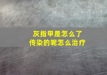 灰指甲是怎么了传染的呢怎么治疗