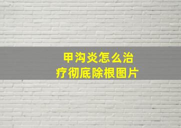 甲沟炎怎么治疗彻底除根图片