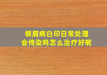 银屑病白印日常处理会传染吗怎么治疗好呢